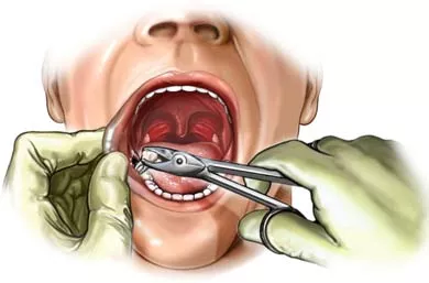 948-tooth-extraction-reas