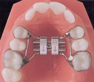 807-avoid-teeth-extractio