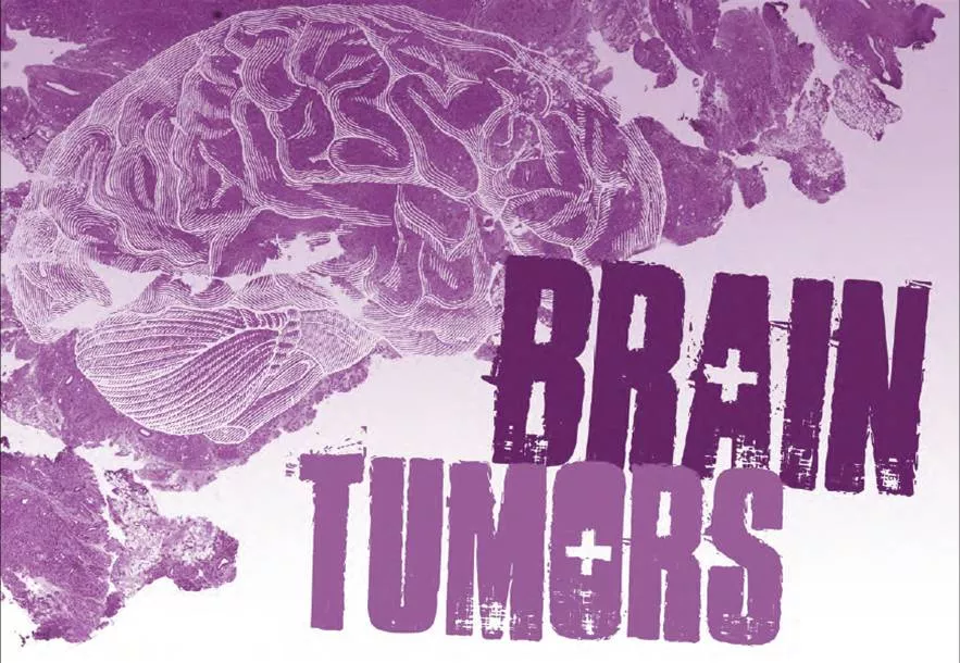 867-tumors-radiations.jpg